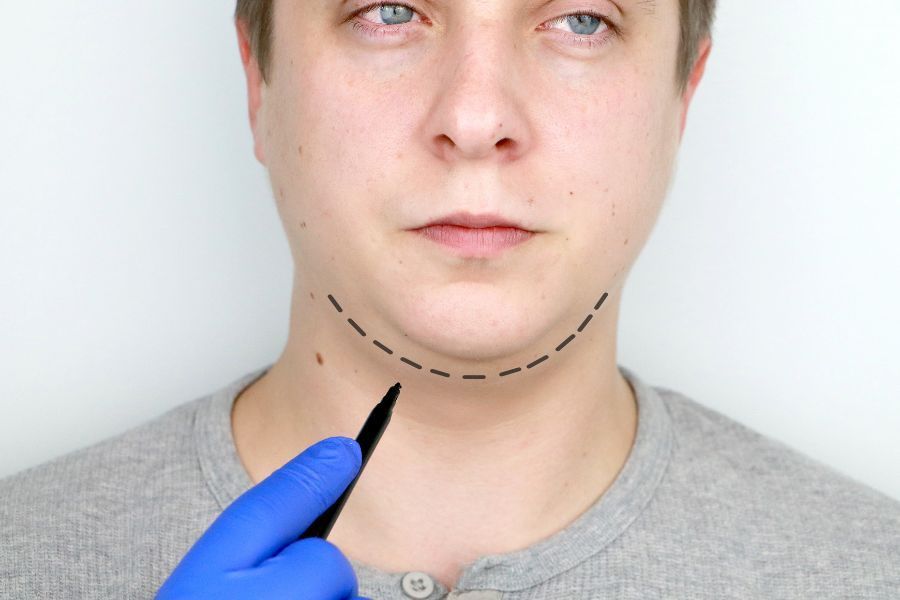 Mentoplastia