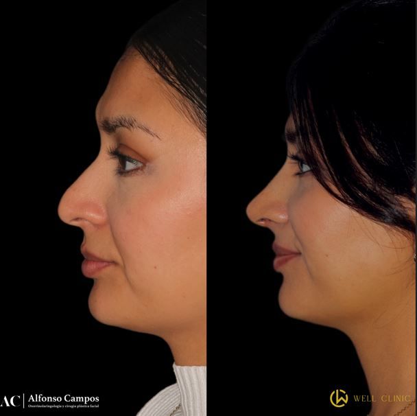 rinoplastia ultrasónica León 2