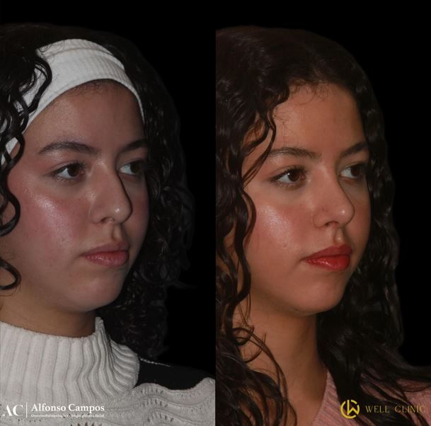 rinoplastia ultrasónica León 3
